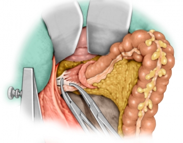 Mesorectal dissection