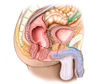 Anterior rectal dissection