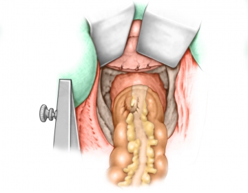 Rectal palpation