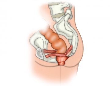 Exposing the puborectalis muscle