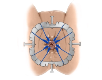 Colocación del sistema retractor Lone Star; inyección submucosa en el canal anal