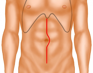 Skin incision and exposure