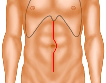Skin incision and exposure