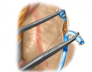 Managing the inferior mesenteric vein