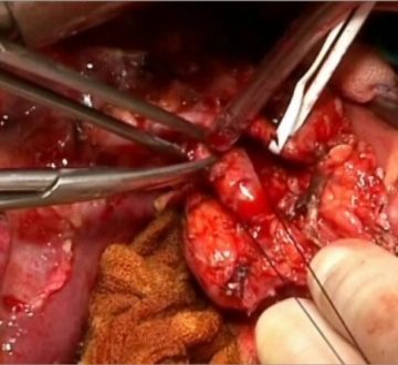 Transection del conducto colédoco