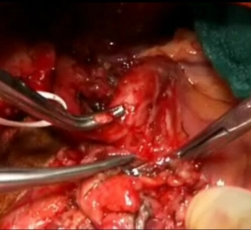 Sección A. gastroduodenalis