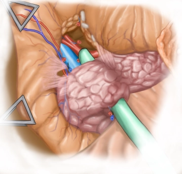 Transecting the pancreas and CBD