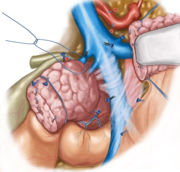 Detaching the pancreatic head