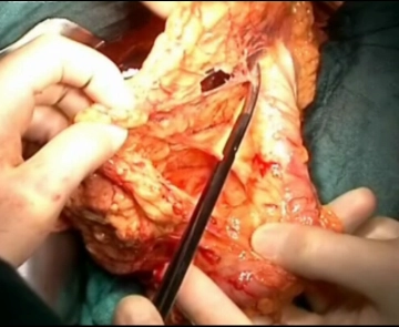 Apertura de la bolsa omental