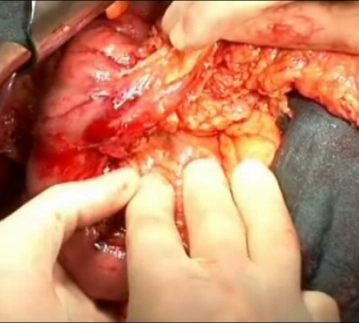 Palpación de la cabeza del páncreas