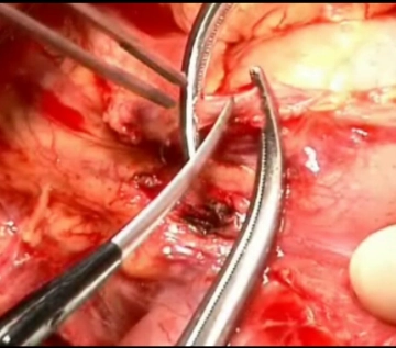 Ligadura A. gástrica derecha