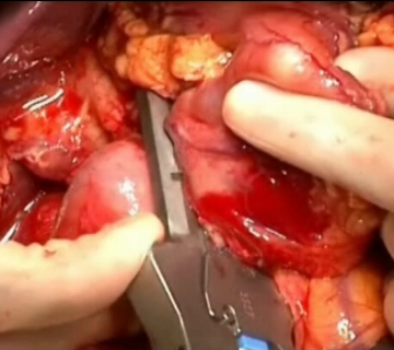 Transection del duodeno postpilórico