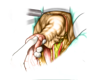 Entering the lesser pelvis