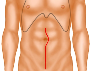 Skin incision and exposure