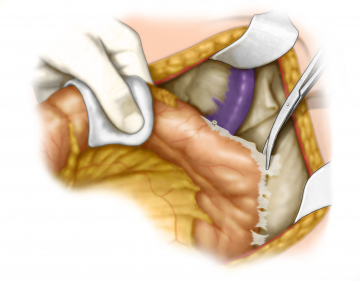 Freeing the sigmoid laterally