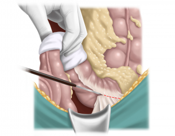 Freeing the splenic flexure