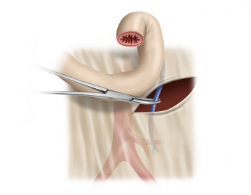 Dividing the inferior mesenteric artery