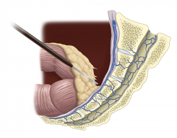 Mesorectal dissection