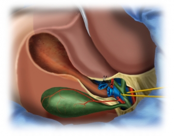 Vessel ligation