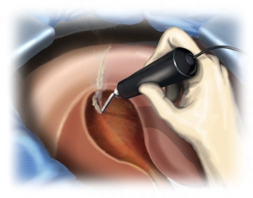 Ischemic Demarcation