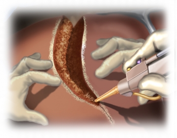 Dividing the hepatic parenchyma