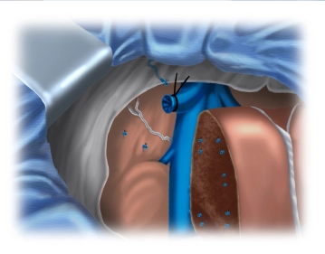Transection of the right hepatic vein