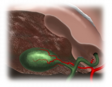 Dividing the right hepatic duct