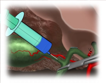 Exclusion of bile leaks, removal of the gallbladder