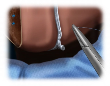 Refixation of the ligamentum teres hepatis