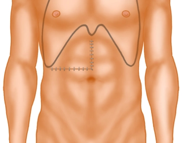 Abdominal wall closure