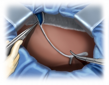 Dividing the falciform ligament