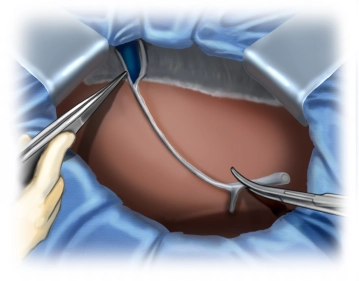 Dividing the falciform ligament
