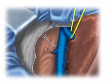 Exposing the inferior vena cava