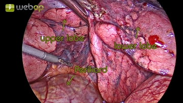 Preparation of the visceral pleura in the interlobium and hilum