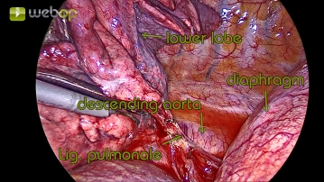 Dissektion des Ligamentum pulmonale