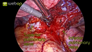 Circular visualization of the inferior lobe vein