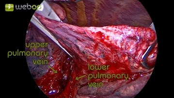 Dissection of the bridging parenchymal in the interlobium