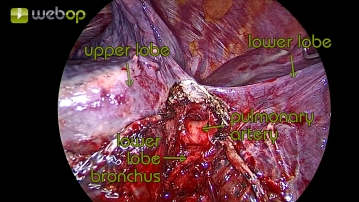 Darstellung der Pulmonarterie und des Unterlappenbronchus