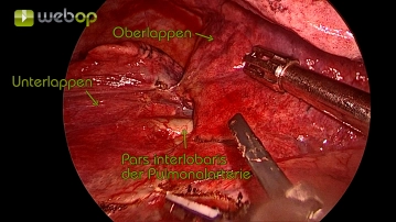 Preparation of the interlobium between the upper, middle, and lower lobes