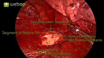 Preparation of the pulmonary artery with visualization of the segmental artery A6