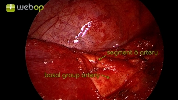 Dissection of the segmental artery A6