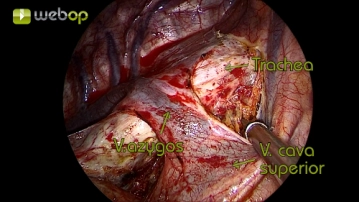 Preparation of the mediastinal pleura above the azygos vein