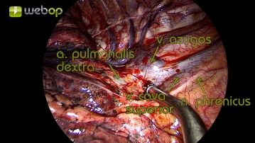 Präparation der Pleura mediastinalis unterhalb der Vena azygos