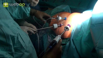 Placement of accesses for VATS thymectomy