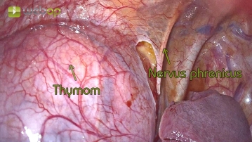 Darstellen des Nervus phrenicus und Festlegung der lateralen Resektionsgrenze