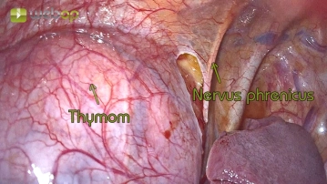 Visualization of the phrenic nerve and determination of the lateral resection margin