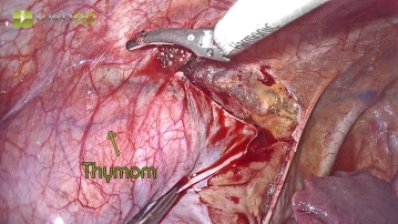 Circular preparation of the mediastinal pleura