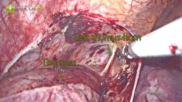 Visualization of the left thymic horn