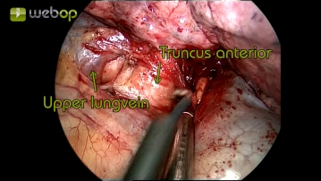 Preparation of the lung hilum