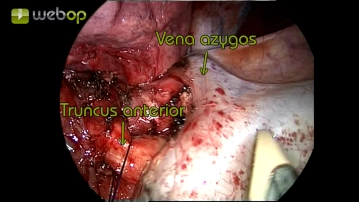 Resection of the anterior trunk